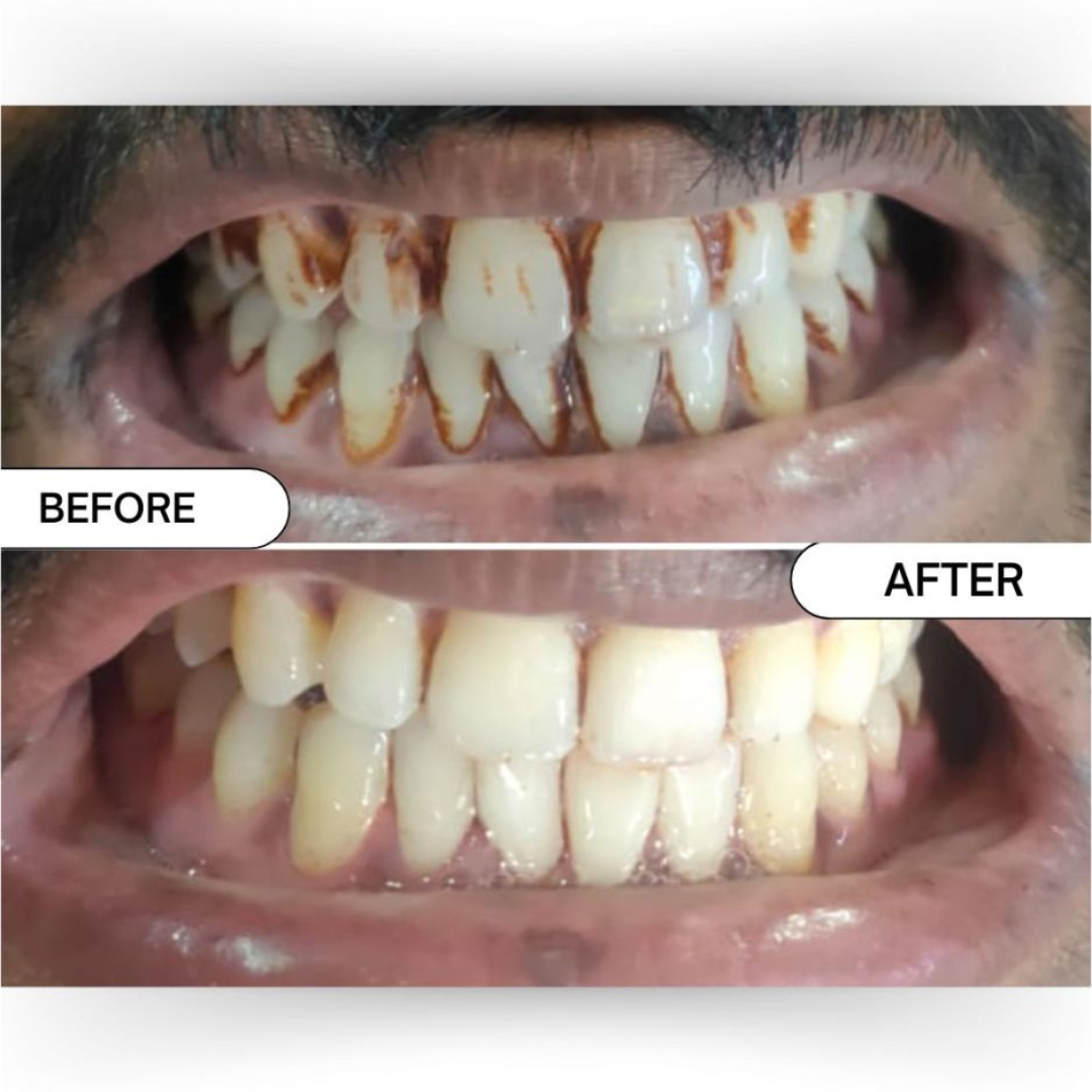 Blinqo Teeth Whitening Pen